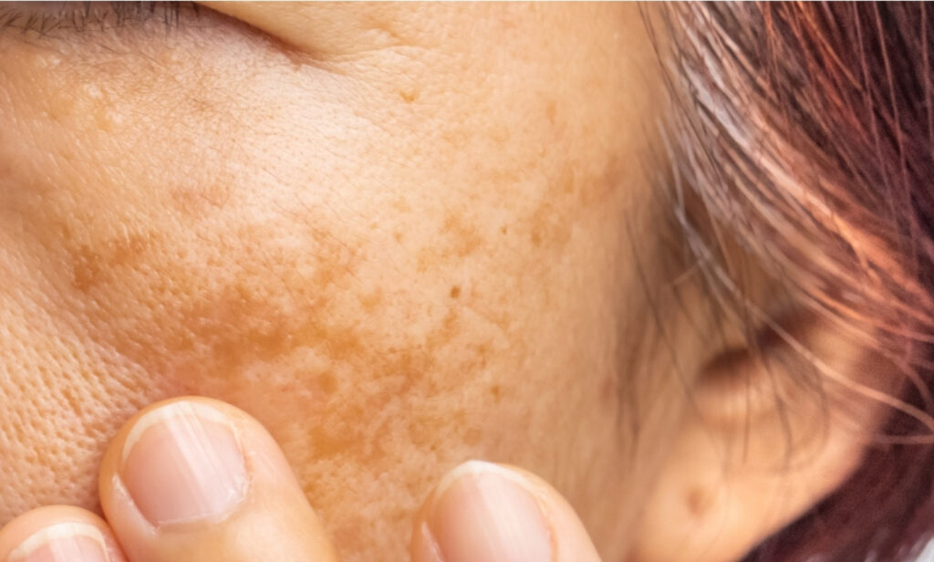 Como tratar o melasma